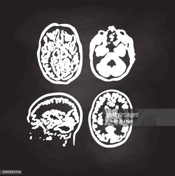 brain scan image blackboard - brain cancer stock illustrations