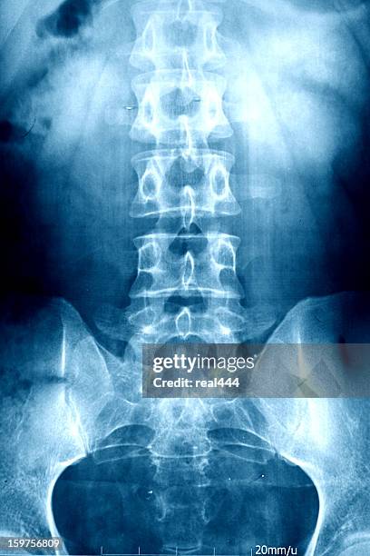 xray - hip body part 個照片及�圖片檔