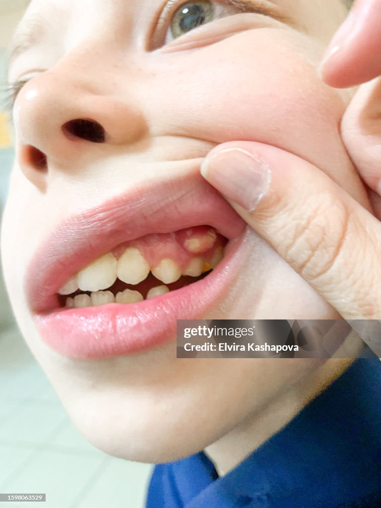 Purulent fistula over the tooth of a boy 11 years old close-up