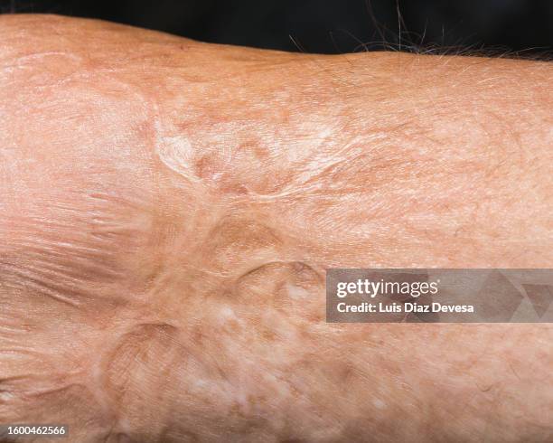 severely injured arm from burn - incineration stock pictures, royalty-free photos & images