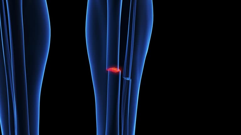 Tibia Animation 22 Tibia Fracture Stock Videos, Footage, & 4K Video Clips - Getty Images