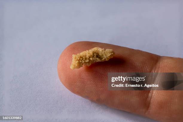 8mm human kidney stone on a finger - smaller organ stock pictures, royalty-free photos & images