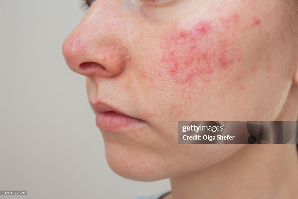 Woman suffering from the skin chronic disease rosacea on her face in the acute stage.
