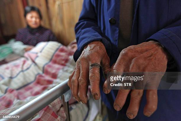 This picture taken on January 28, 2013 shows Fu Xuepeng's father Fu Minzu showing his coarse hands as he stands next to the bed of his son Fu Xuepeng...
