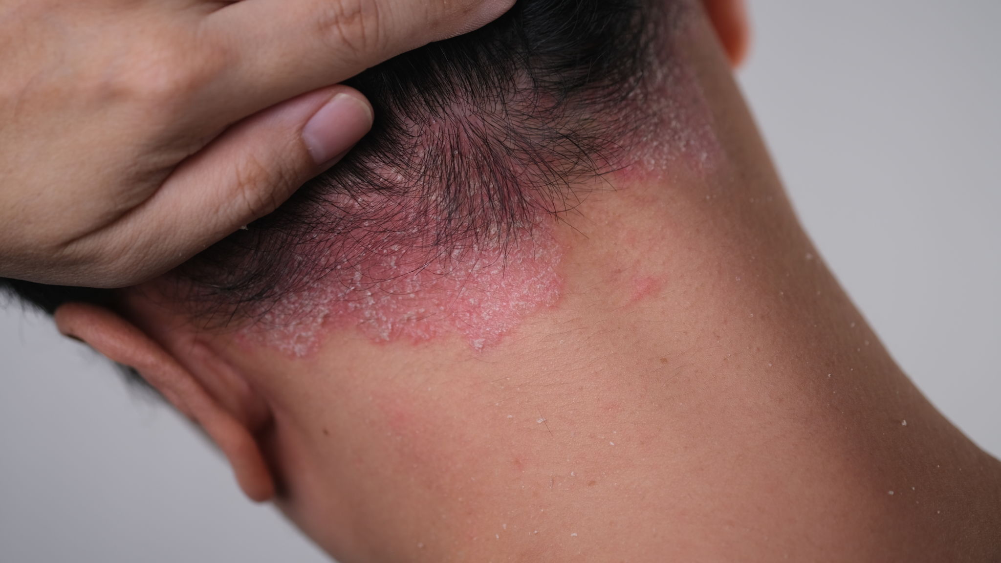 Psoriasis on the nape of a man. skin with psoriasis. Psoriasis on the nape of a man. skin with psoriasis.