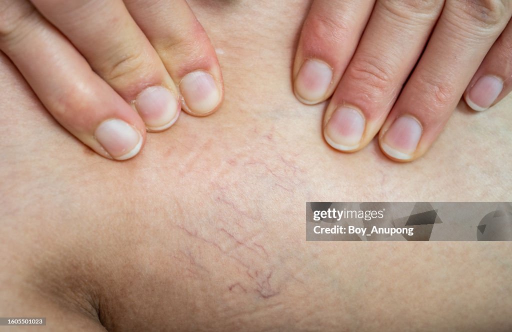 Close up of spider veins occur on woman thigh.
