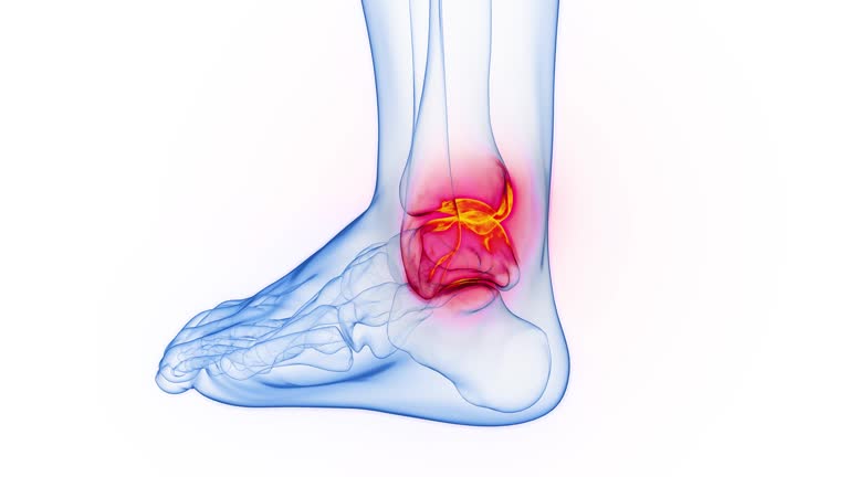 Sprain Animation Ankle Sprain Videos and HD Footage - Getty Images
