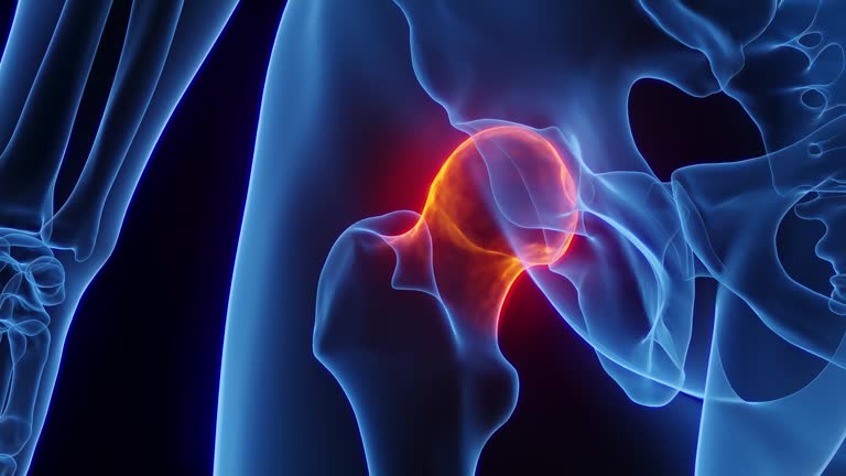 Inflamd 42 Inflamed Hip Joint Stock Videos, Footage, & 4K Video Clips - Getty ...