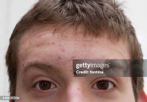 Students Skin Problems Teenage Skin Problems High-Res Stock Photo - Getty Images
