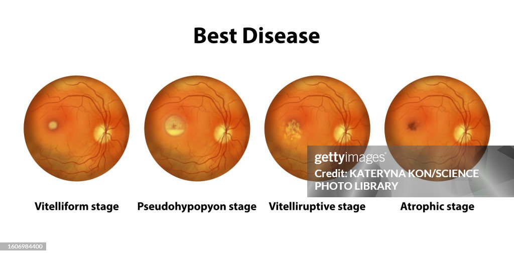 Stages Of Best Vitelliform Macular Dystrophy Illustration High Res stages-of-best-vitelliform-macular-dystrophy-illustration-high-res
