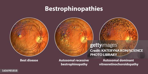 bestrophinopathies, illustration - hyperpigmentation stock illustrations