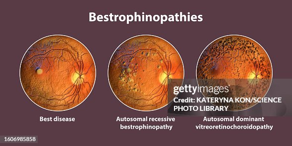 Bestrophinopathies, illustration Bestrophinopathies, illustration