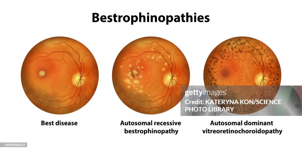 Bestrophinopathies, illustration