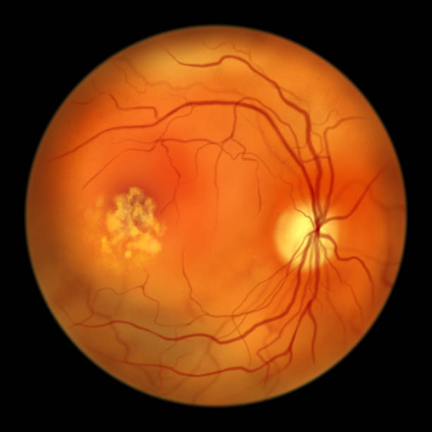 Colpite Macular 9,170 Macula Edema High Res Illustrations - Getty Images