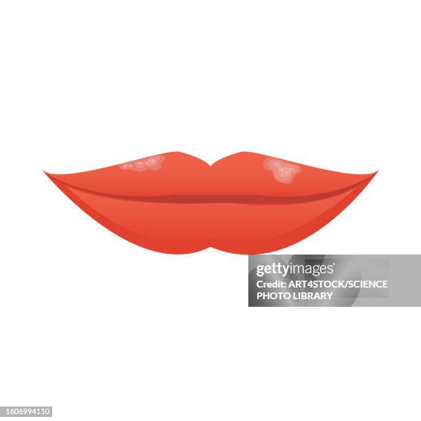 ilustrações, clipart, desenhos animados e ícones de cold sore, illustration - herpes labial