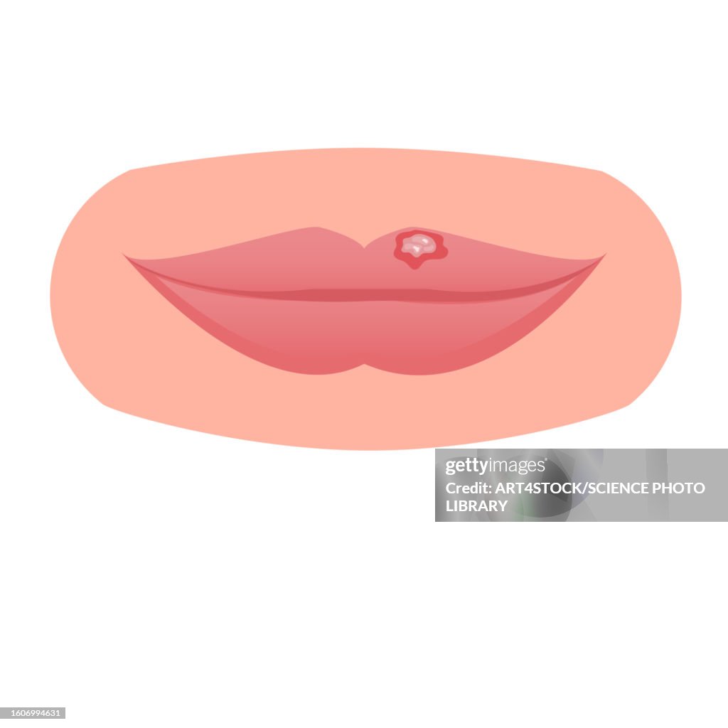 Cold sore, illustration