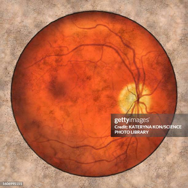 Normal Optoms 176 Normal Retina Stock Photos, High-Res Pictures, and Images - Getty ...