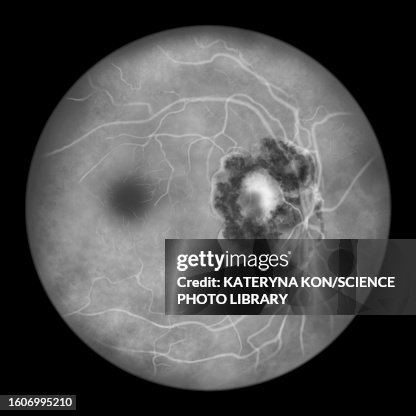 Retinal scar caused by toxoplasmosis, illustration Retinal scar caused by toxoplasmosis, illustration
