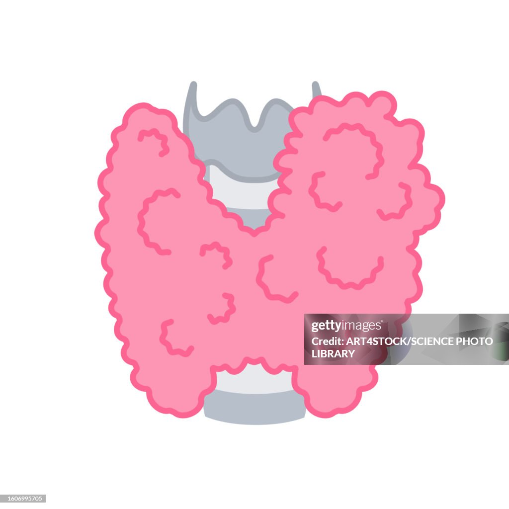 Enlarged thyroid gland, illustration