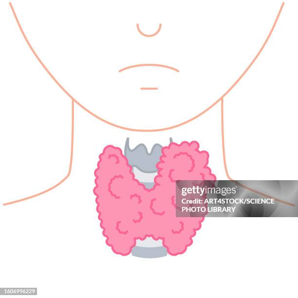 enlarged thyroid gland, illustration - distorted body stock illustrations