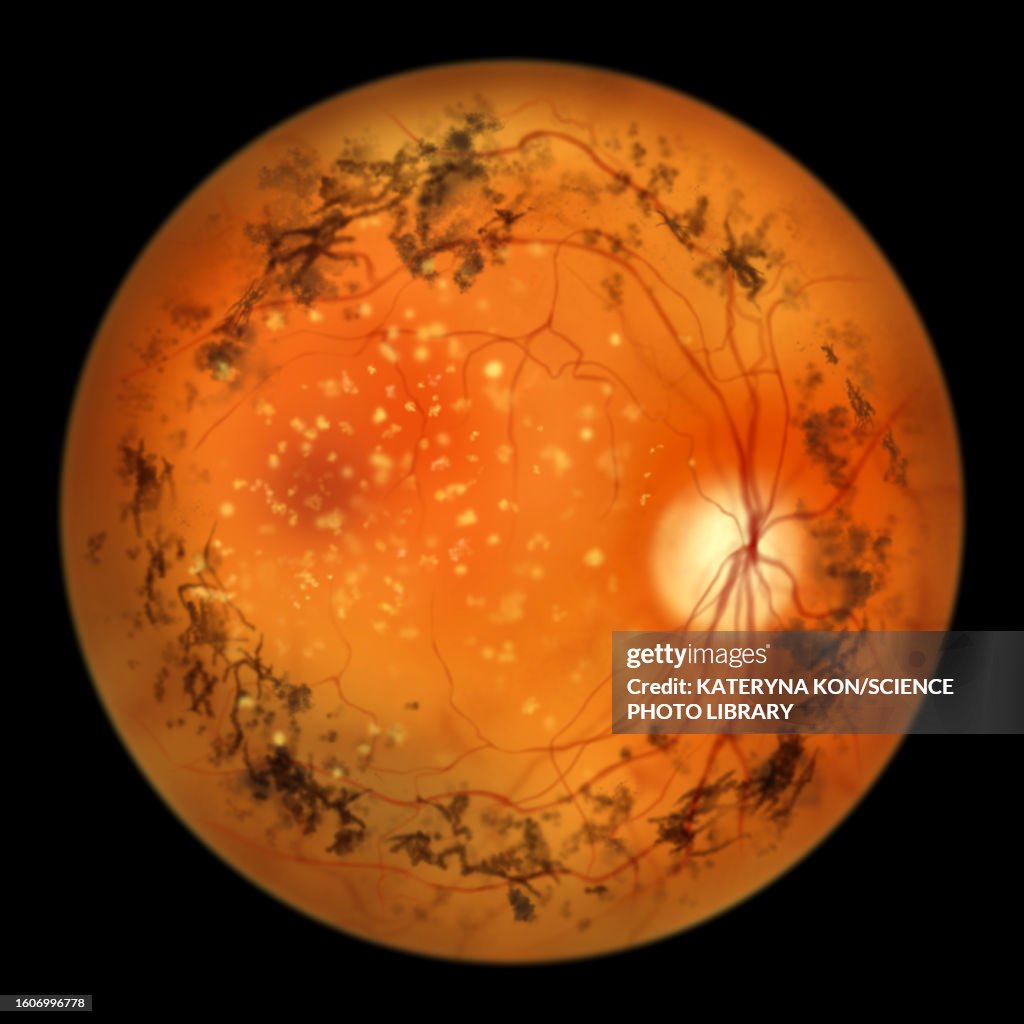Retinitis pigmentosa, illustration