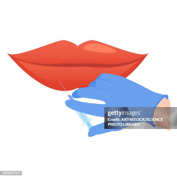 lip augmentation, illustration - cosmetics stock illustrations