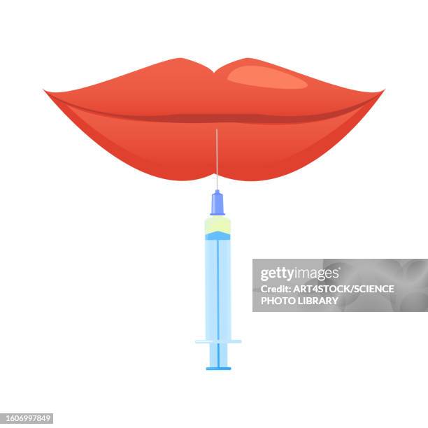 lip augmentation, illustration - surgical equipment stock illustrations