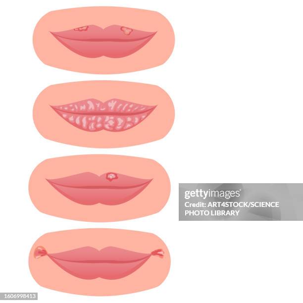 ilustraciones, imágenes clip art, dibujos animados e iconos de stock de lip disorders, illustration - boca seca