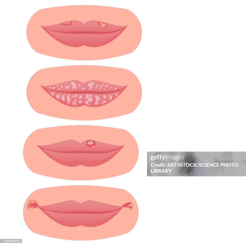 Lip disorders, illustration