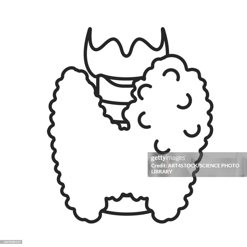 Enlarged thyroid gland, illustration