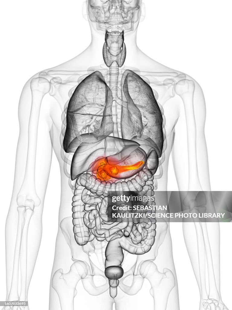 Pancreas cancer, illustration