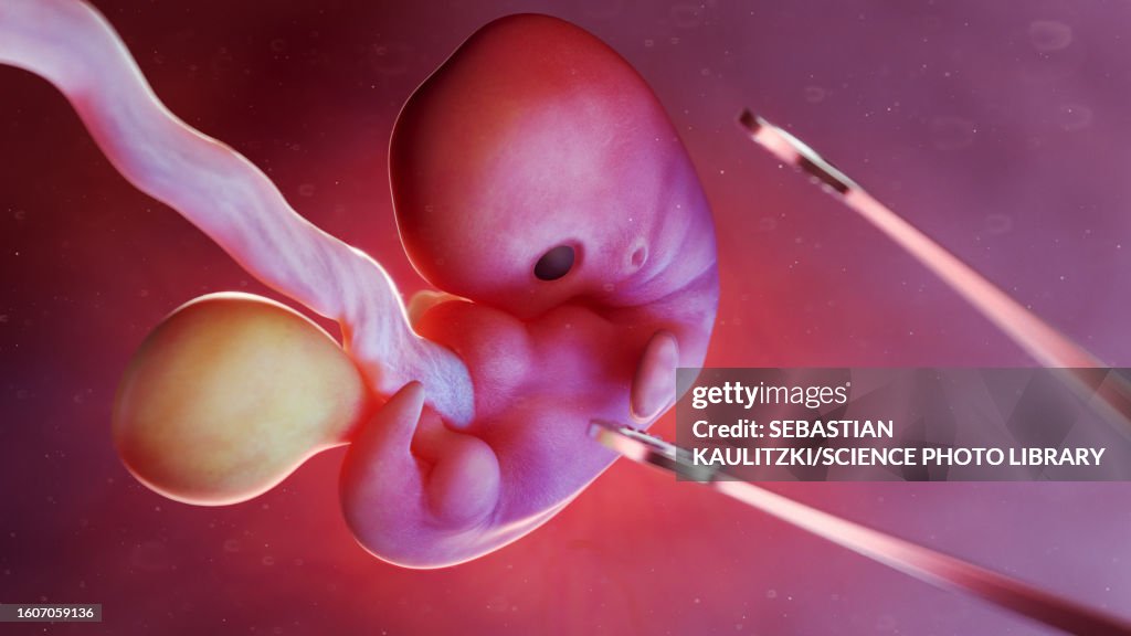 Abortion, conceptual illustration