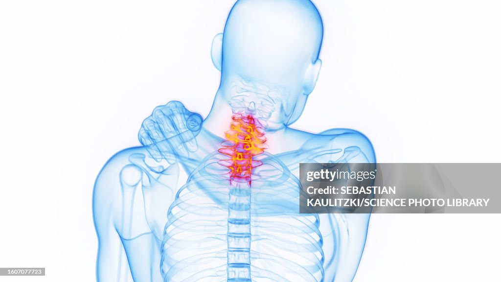 Neck pain, illustration