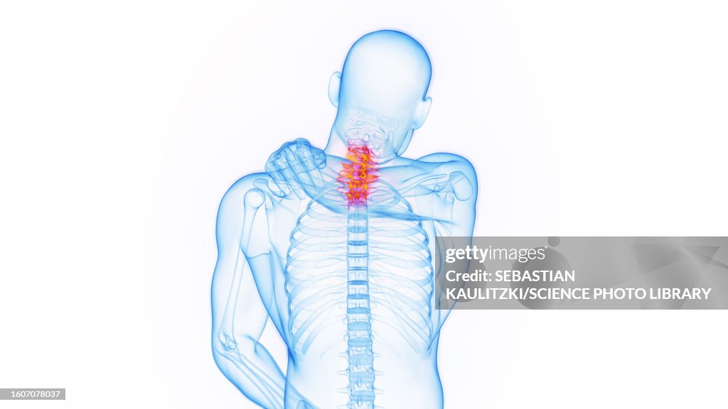 Neck pain, illustration