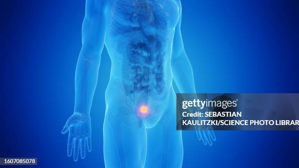 urinary bladder cancer, illustration - bladder cancer stock illustrations