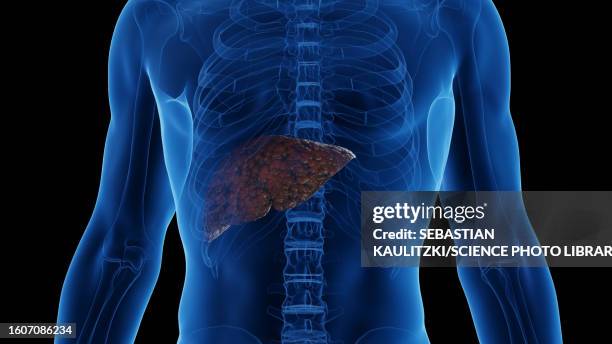 cirrhotic liver, illustration - cirrhosis 幅插畫檔、美工圖案、卡通及圖標