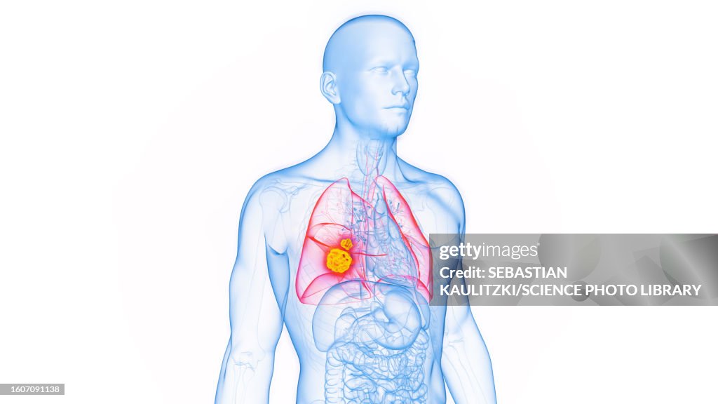 Lung cancer, illustration