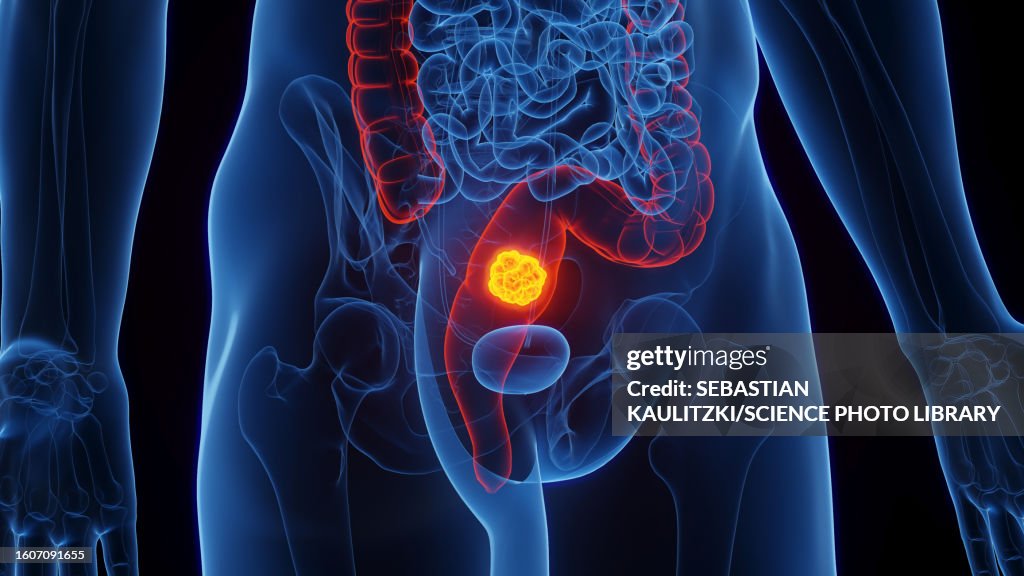 Reca Cancer Map Rectal Cancer Illustration High-Res Vector Graphic - Getty Images