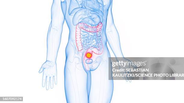 rectal cancer, illustration - colon cancer stock illustrations