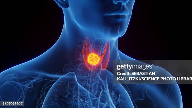 illustrazioni stock, clip art, cartoni animati e icone di tendenza di thyroid cancer, illustration - tiroide