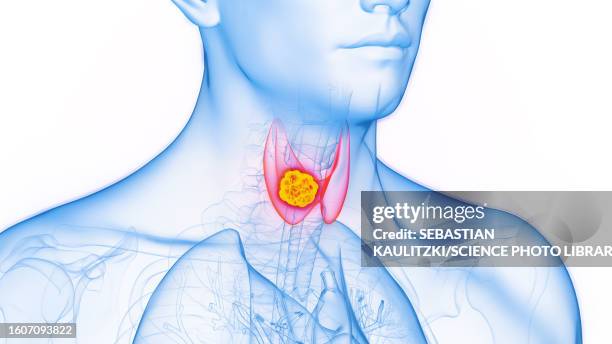 thyroid cancer, illustration - follicular thyroid cancer stock illustrations