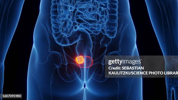 urinary bladder cancer, illustration - carcinoma stock illustrations