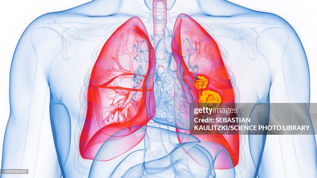 Lung cancer, illustration