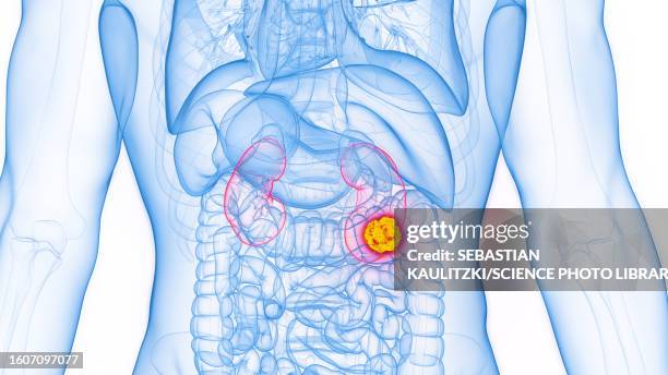 kidney cancer, illustration - kidney cyst stock illustrations