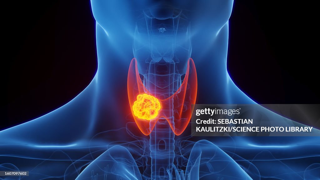 Thyroid cancer, illustration