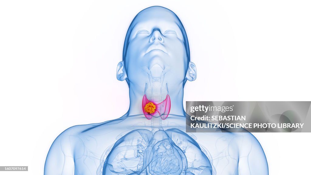 Thyroid cancer, illustration