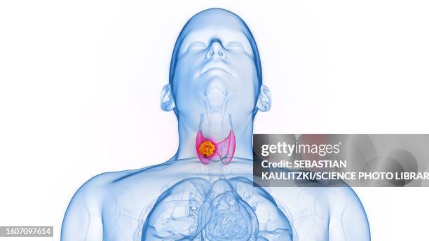 thyroid cancer, illustration - follicular thyroid cancer stock illustrations