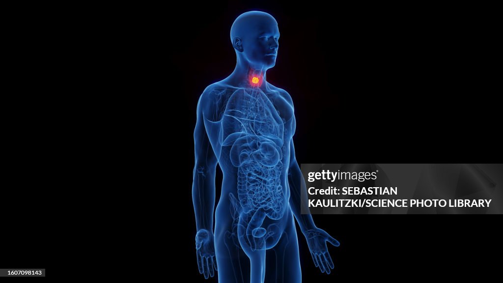 Thyroid cancer, illustration
