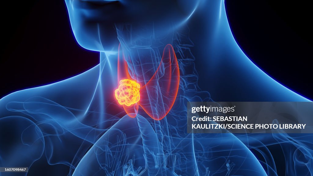Thyroid cancer, illustration