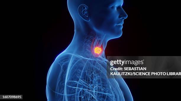 thyroid cancer, illustration - follicular thyroid cancer stock illustrations